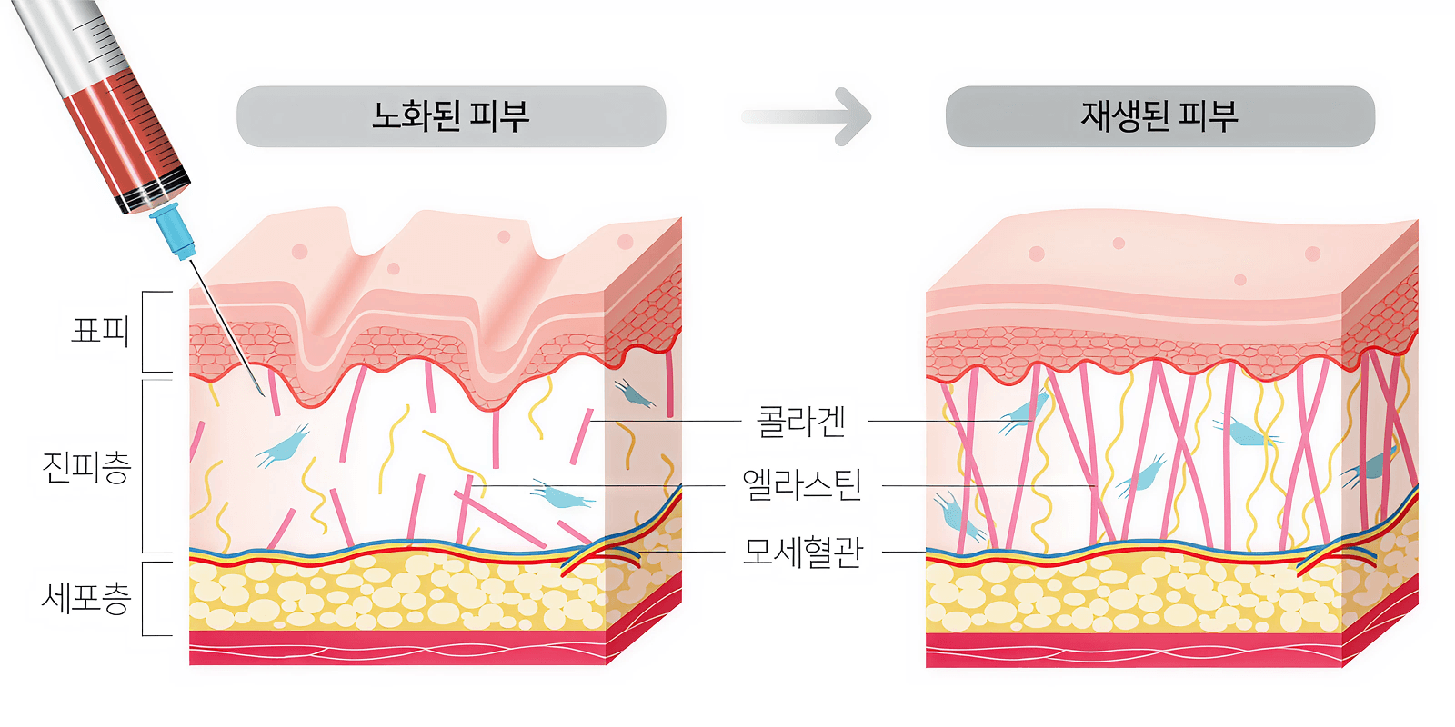 줄기세포 피부 치료 안내 이미지